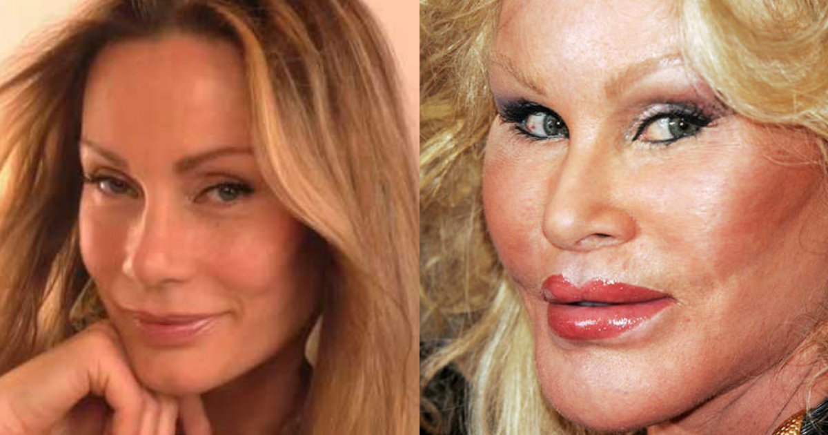 These Extreme Plastic Surgery Cases Will Leave You More Horrified Than Impressed Small Joys 9316