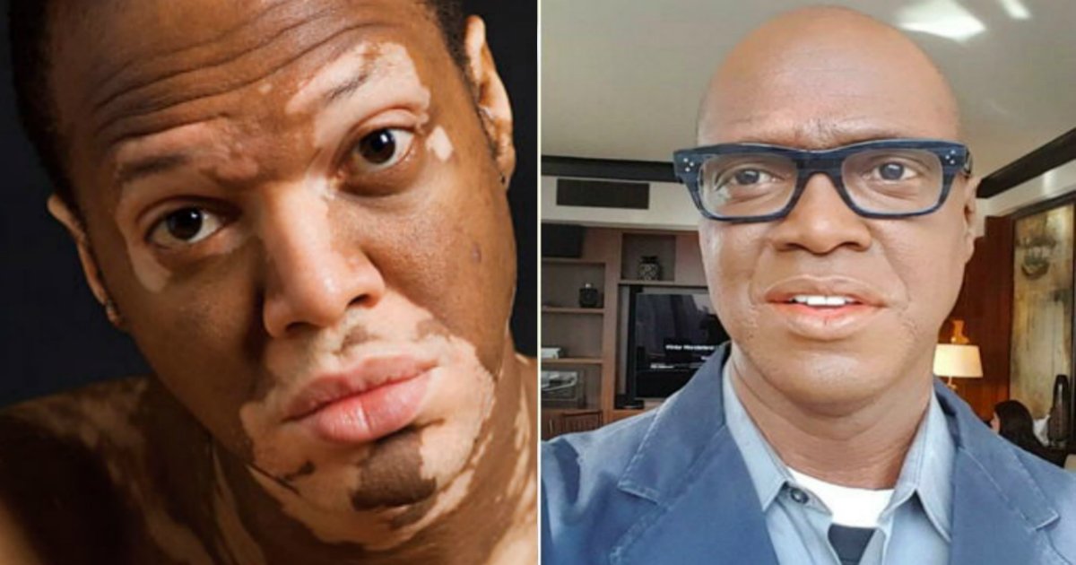 v2gzn9qt236hcrlc0230.jpg?resize=1200,630 - Repórter da Fox TV usa maquiagem pesada por 20 anos para esconder seu vitiligo (vídeo)