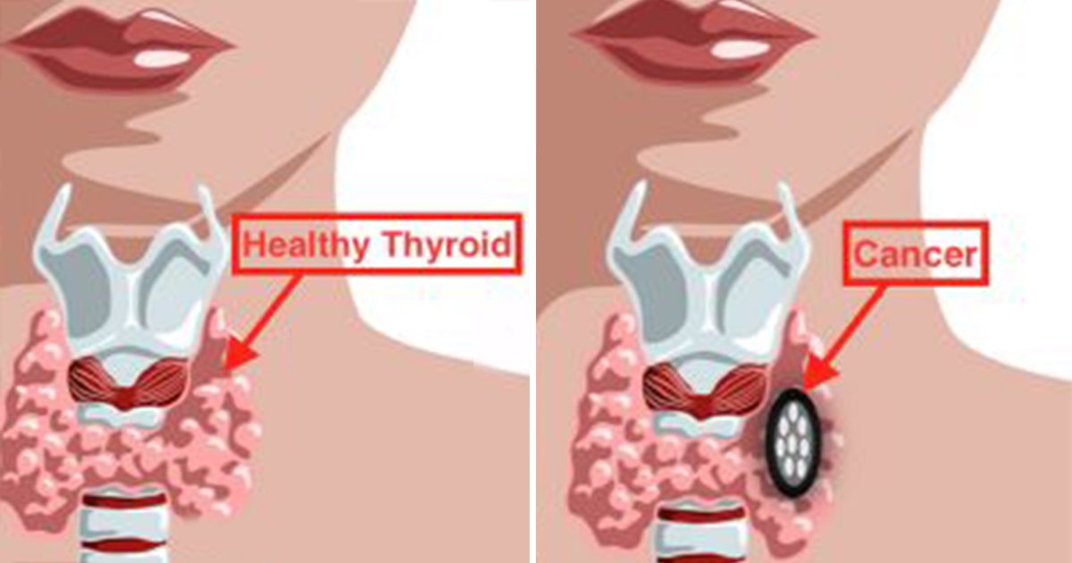 Everything People Need To Know About Thyroid Disorders Causes Symptoms And Treatments Small Joys