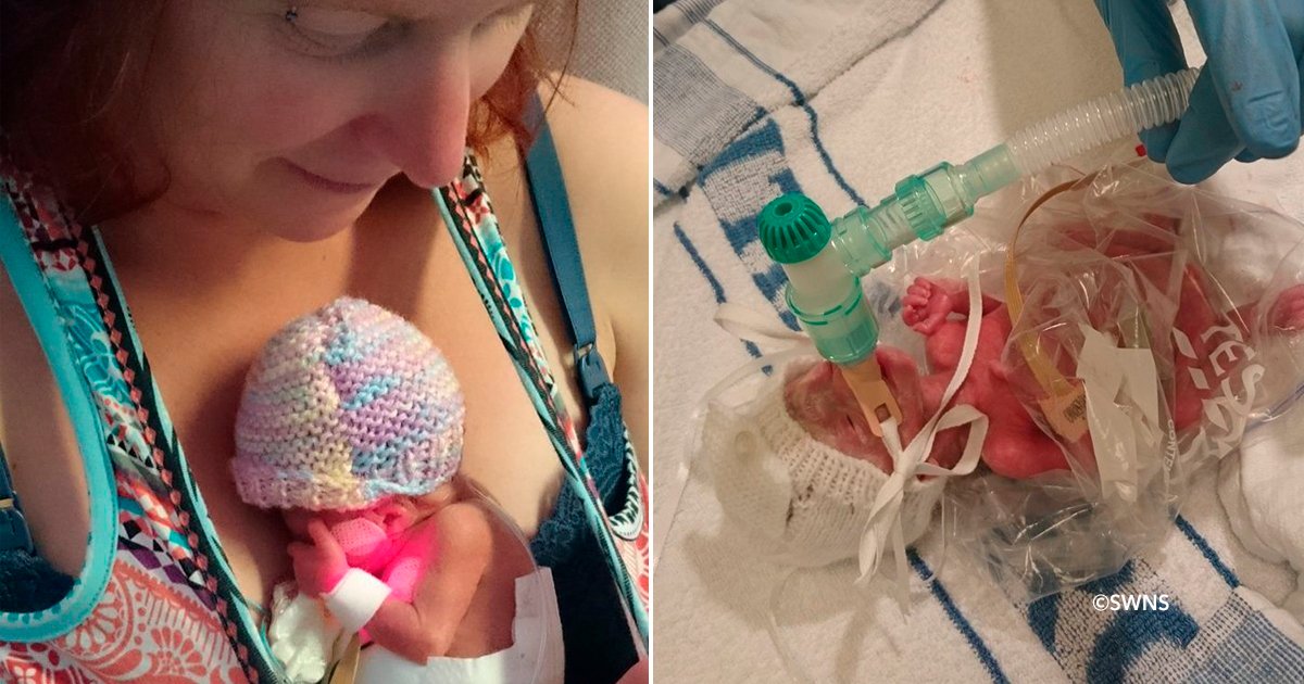 bbzip.jpg?resize=1200,630 - ¡Los médicos salvaron la vida de una recién nacida prematura poniéndola en una bolsa de ziploc!