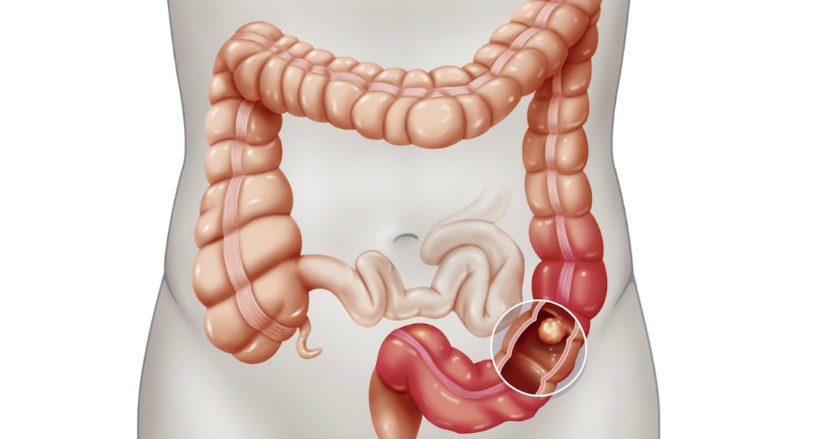 colon.png?fit=1024%2C538&ssl=1&strip=all - Especialistas alertam: Incidência do câncer de cólon está aumentado!