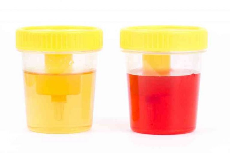 couleur de l'urine-indique-votre-santé-7