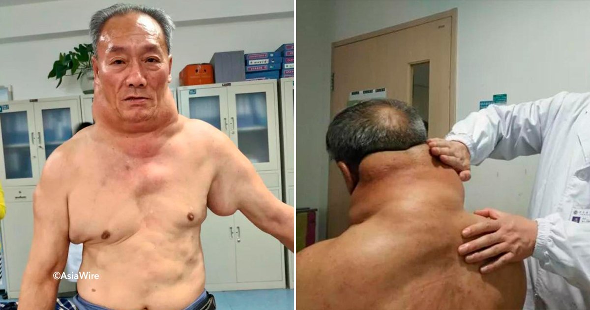 cover22cuello.jpg?resize=1200,630 - A este hombre en China le creció el cuello y los hombros de manera exorbitante, en las redes lo llamaban “Hulk”
