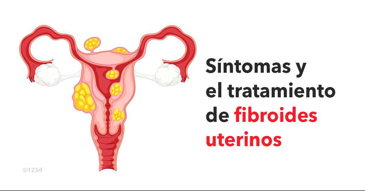 cover22fibro.jpg?resize=412,275 - En esta guía conocerás los síntomas y el tratamiento de fibroides uterinos