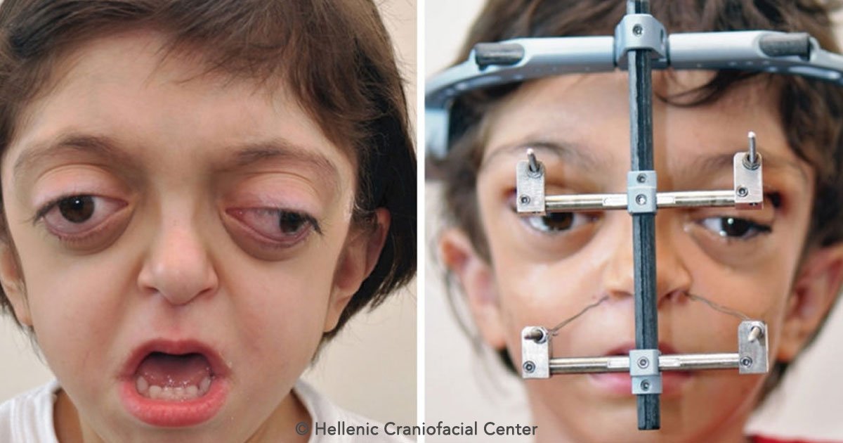 covr.jpg?resize=1200,630 - Un extraño síndrome deformó su cara al nacer, tras someterse a tratamiento logró conocer su verdadero rostro