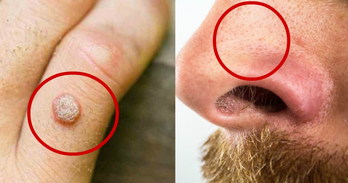 Natural Home Remedies For Dealing With Blackheads Warts Moles Age Spots And Skin s Small Joys