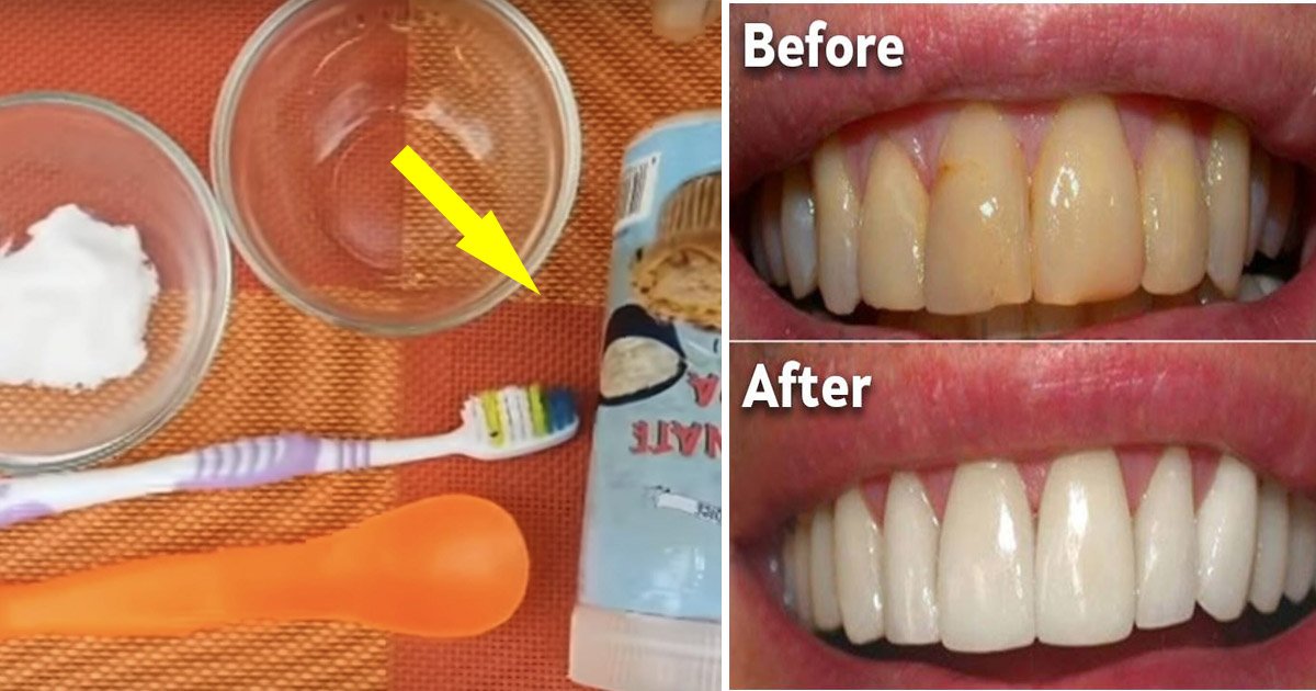 plaque.jpg?resize=1200,630 - Household Remedy For Shiny Teeth: Baking Soda Can Be Used To Get Rid Of Plaque