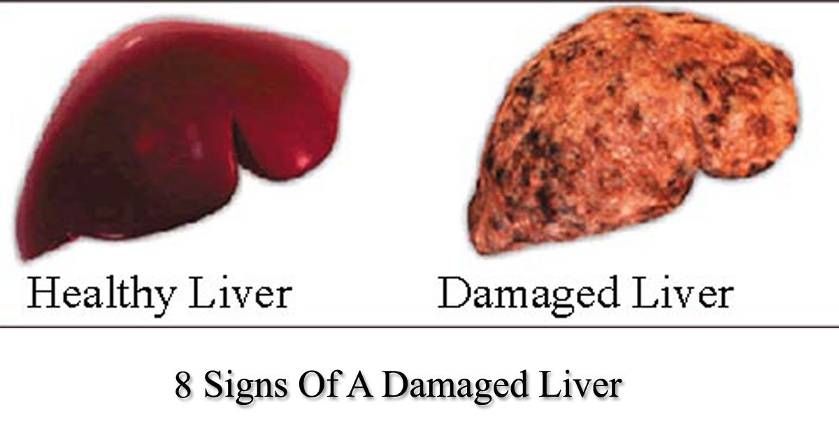 untitled 1 146.jpg?resize=1200,630 - 8 Alarming Signs And Symptoms Of Liver Disease That Shouldn't Be Ignored
