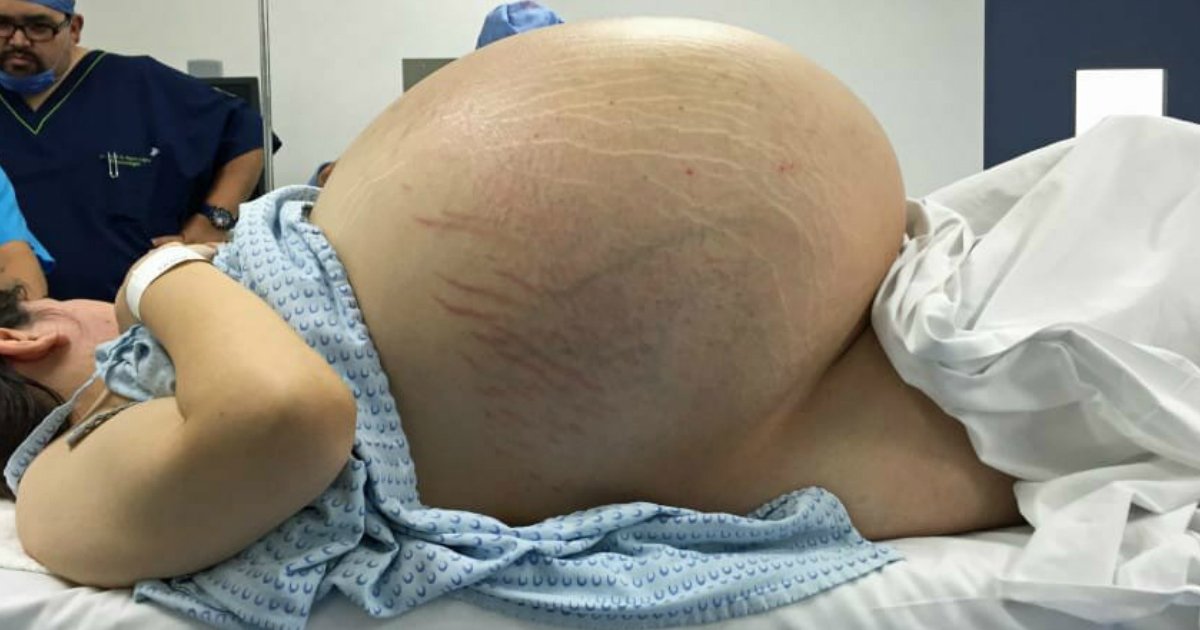 untitled 1 2.jpg?resize=1200,630 - Mujer parece estar embarazada de 10 bebés, los escáneres revelan un quiste masivo de CINCO PIEDRAS en su vientre