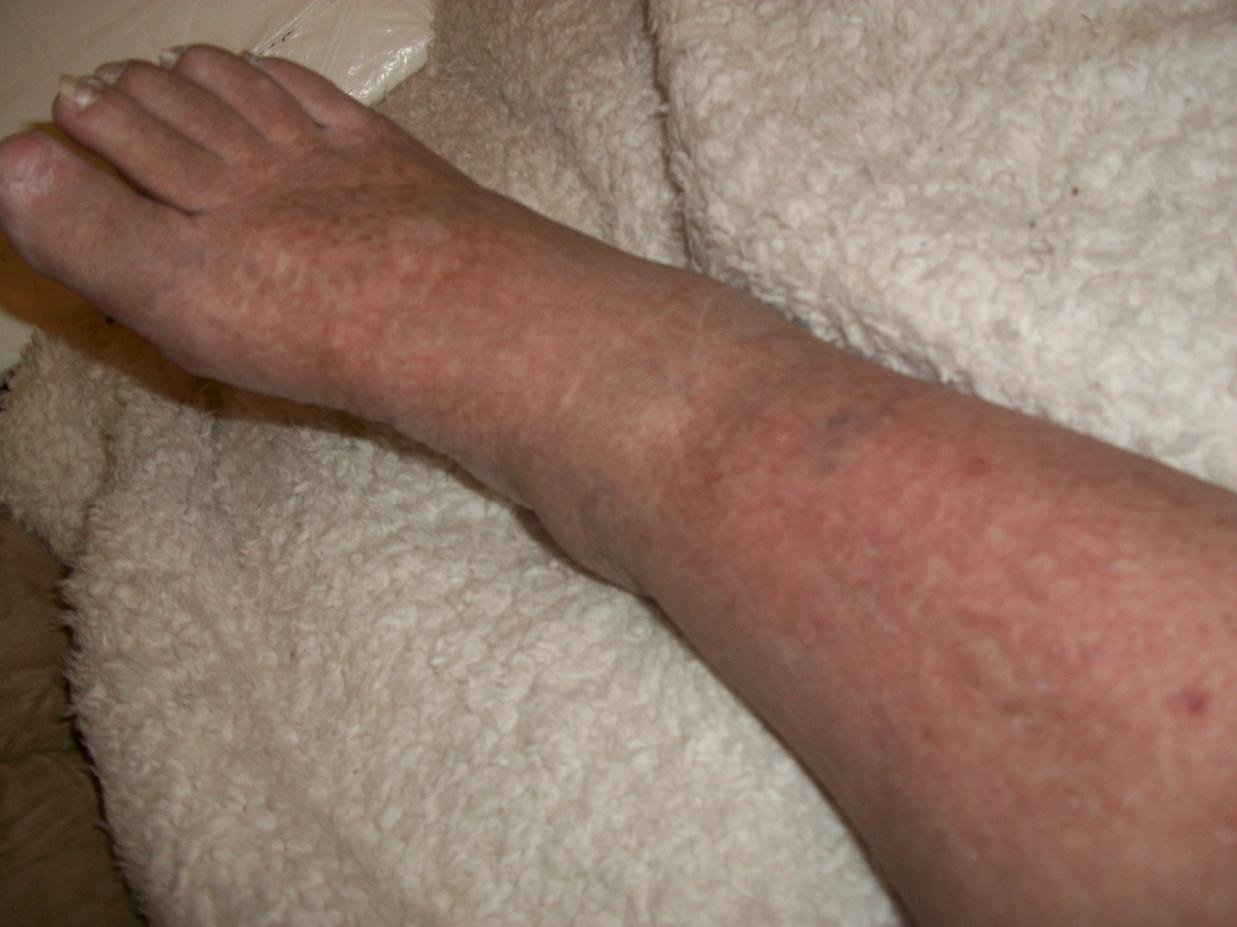 symptom of blood clot in leg