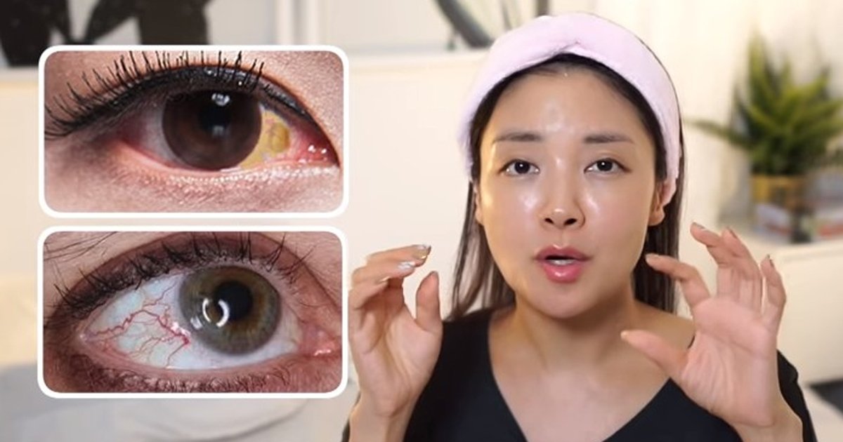 2 290.jpg?fit=1024%2C538&ssl=1&strip=all - 수건·면봉·점안액으로 깨끗하고 하얀 눈자위 만드는 방법