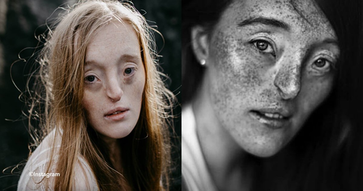 2 cov.jpg?resize=1200,630 - Ilka Brühl, la modelo que nació con una extraña condición facial y rompe todos los esquemas en Instagram