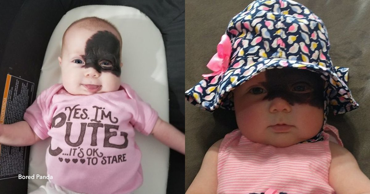 5 cover 2.jpg?resize=1200,630 - Esta beba nació con una marca en la cara y se convirtió en una "pequeña superheroína"