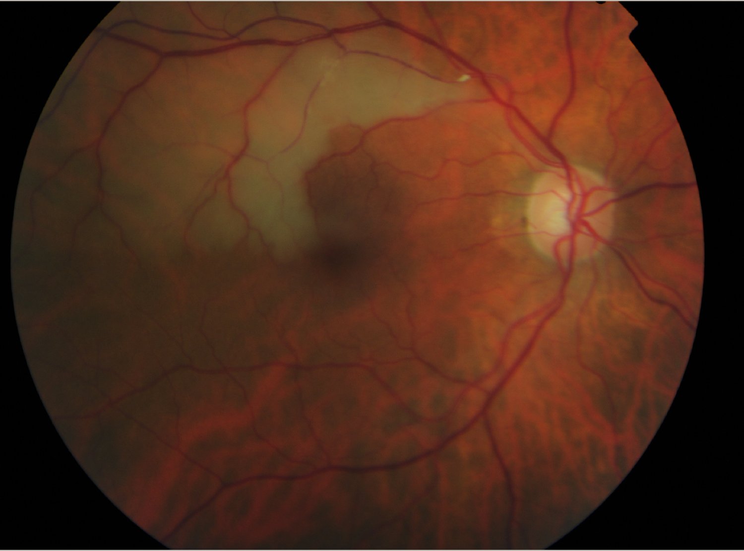Clot in retina