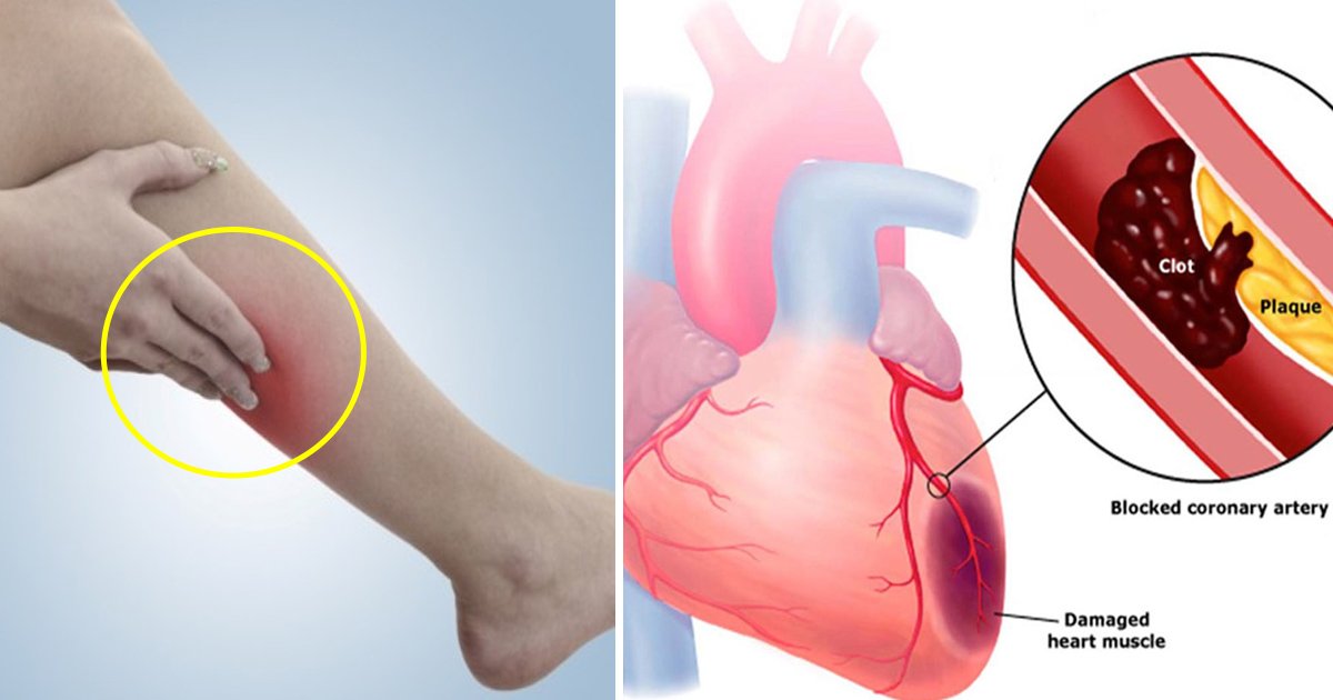 what-is-a-blood-clot-unc-hemophilia-and-thrombosis-center