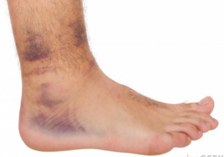 8 Warning Signs Of Blood Clot People Should Be Aware Of - Small Joys