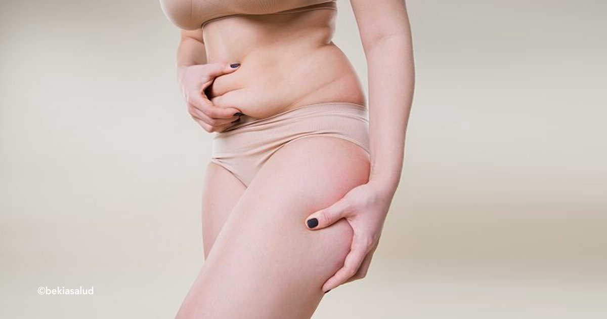 cover22lip 2.jpg?resize=412,275 - Es una patología confundida con obesidad o celulitis, por eso es importante saber si tienes lipedema y tratarlo a tiempo