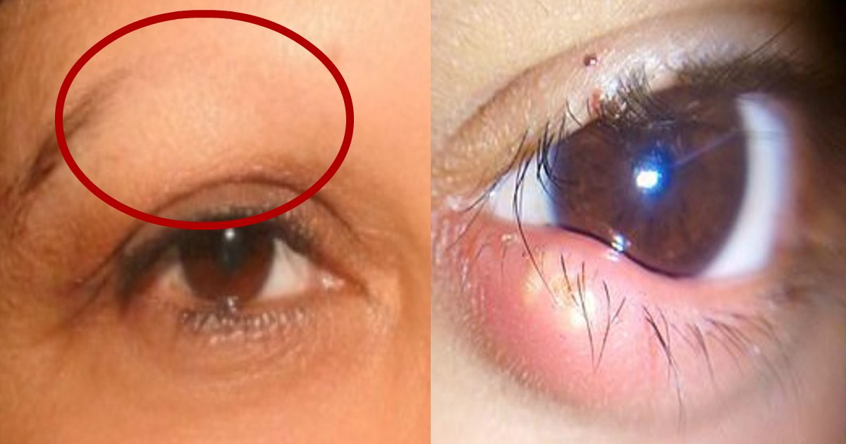 eye condition.jpg?resize=1200,630 - 7 choses importantes que vos yeux révèlent sur votre santé