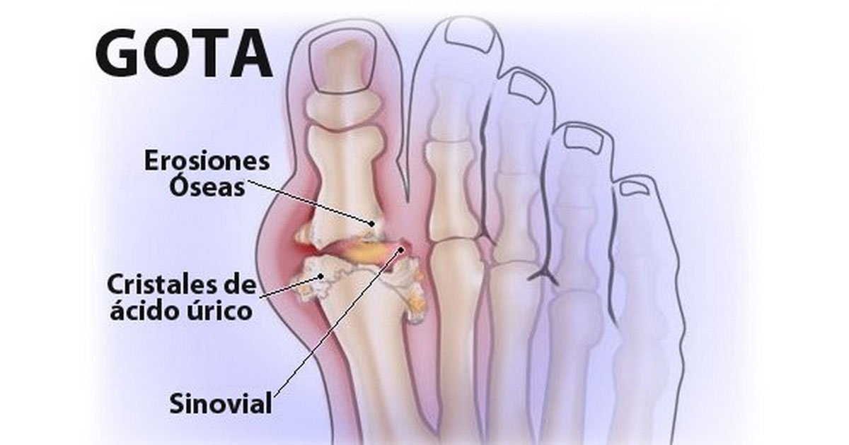 gota.jpg?resize=412,275 - 6 increíbles consejos para disminuir los efectos de la gota en tu cuerpo y mejorar la función en tus articulaciones