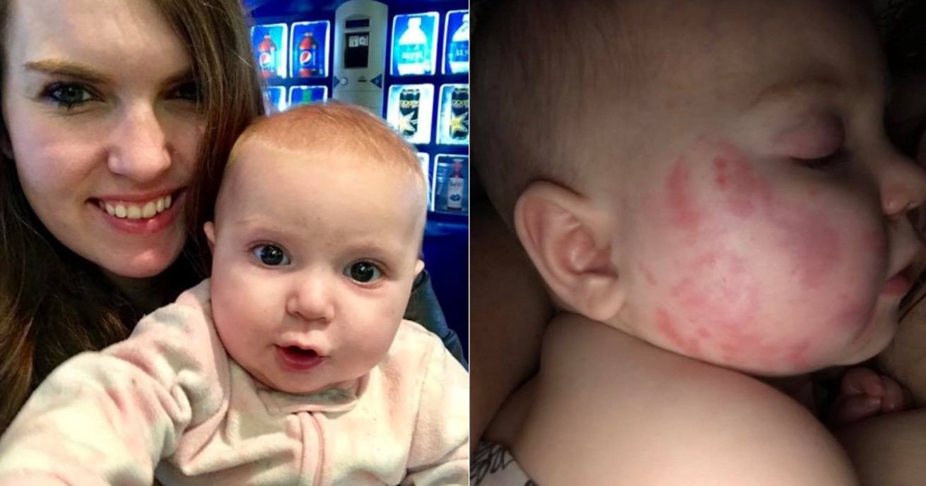 meet.jpg?resize=1200,630 - Mother Enraged Seeing Red Bite Marks On Daughter's Face After Picking Up From Daycare