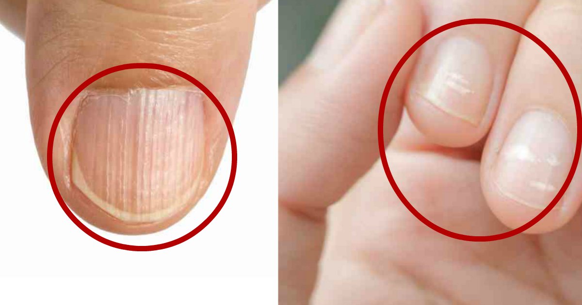 nail signs.jpg?resize=1200,630 - How Your Fingernails Might Indicate Something Is Wrong With Your Health