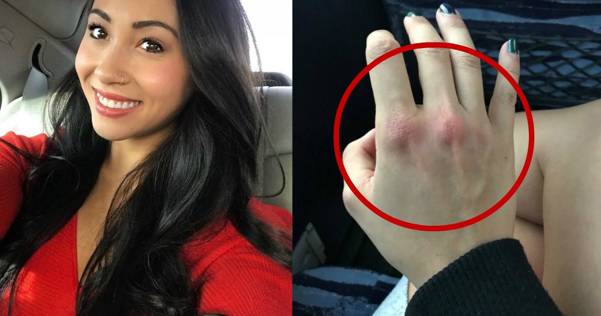punching sexual assault.jpg?resize=1200,630 - Une femme partage des photos de ses doigts enflés après avoir été victime d'une agression sexuelle