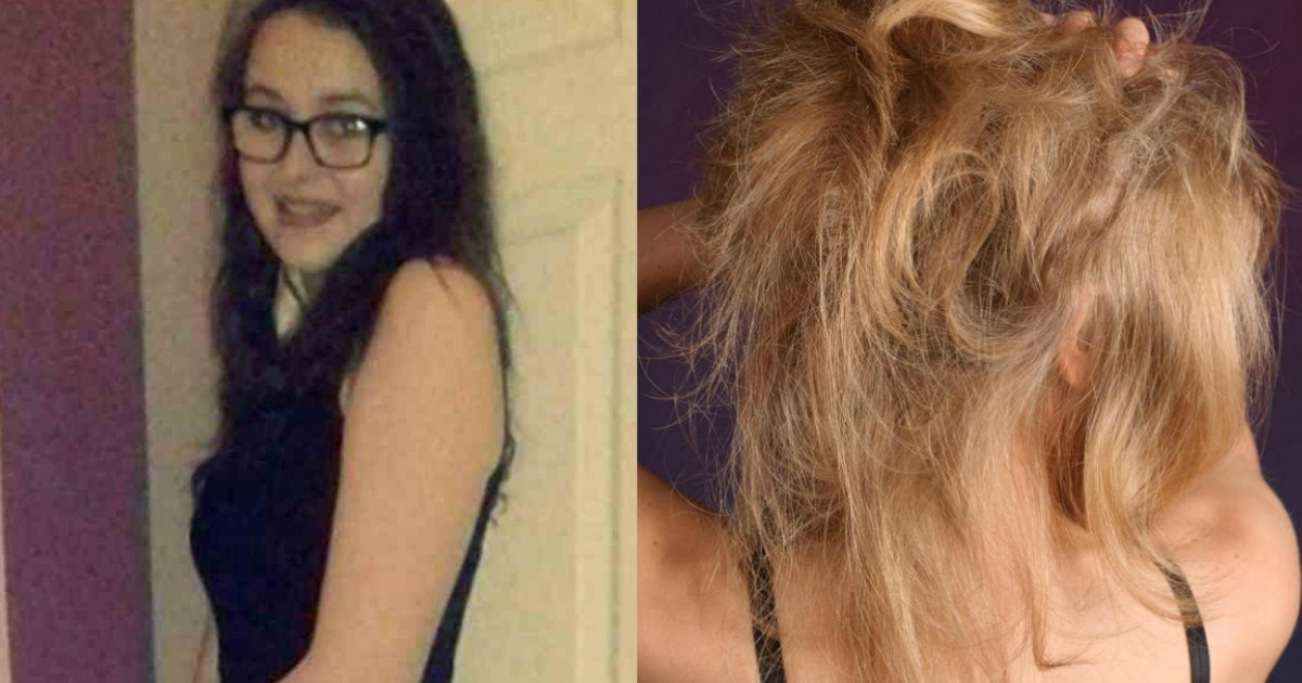 repunzel syndrome.jpg?resize=412,232 - Une jeune fille de 16 ans atteinte du syndrome de Rapunzel est morte après avoir mangé ses propres cheveux
