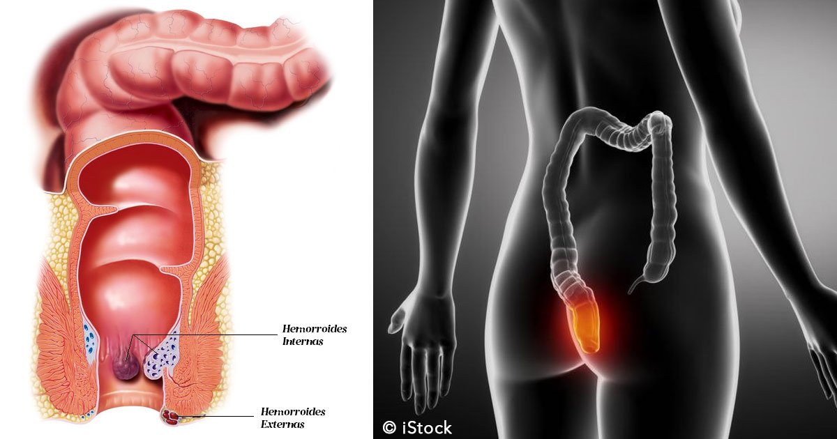 untitled 1 21.jpg?resize=412,275 - 6 simples tratamientos para prevenir las hemorroides y aliviar las molestias