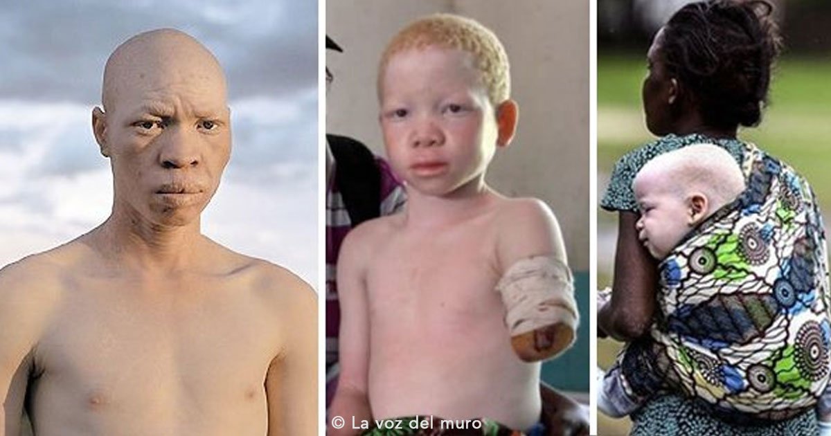 untitled 1 7.jpg?resize=412,275 - Los albinos en África son cazados y vendidos para prácticas de brujería, viven en la marginación y el miedo