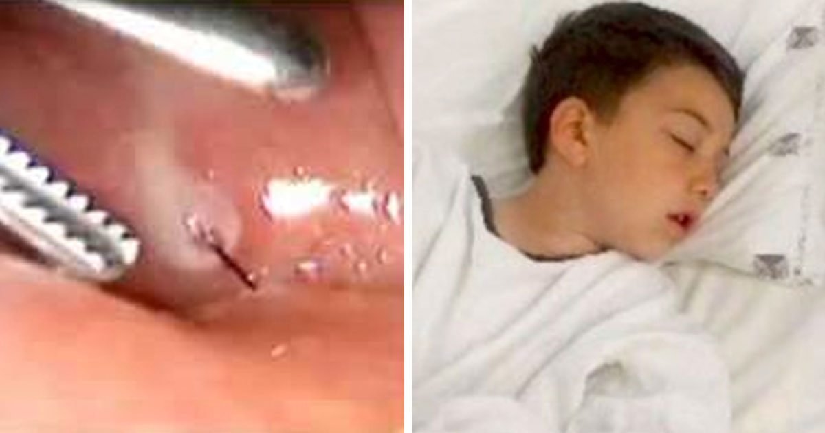 a 4.jpg?resize=1200,630 - Grill Brush Dangers: 6-Year-Old Boy Almost Dies After Eating Burger With A Wire In It
