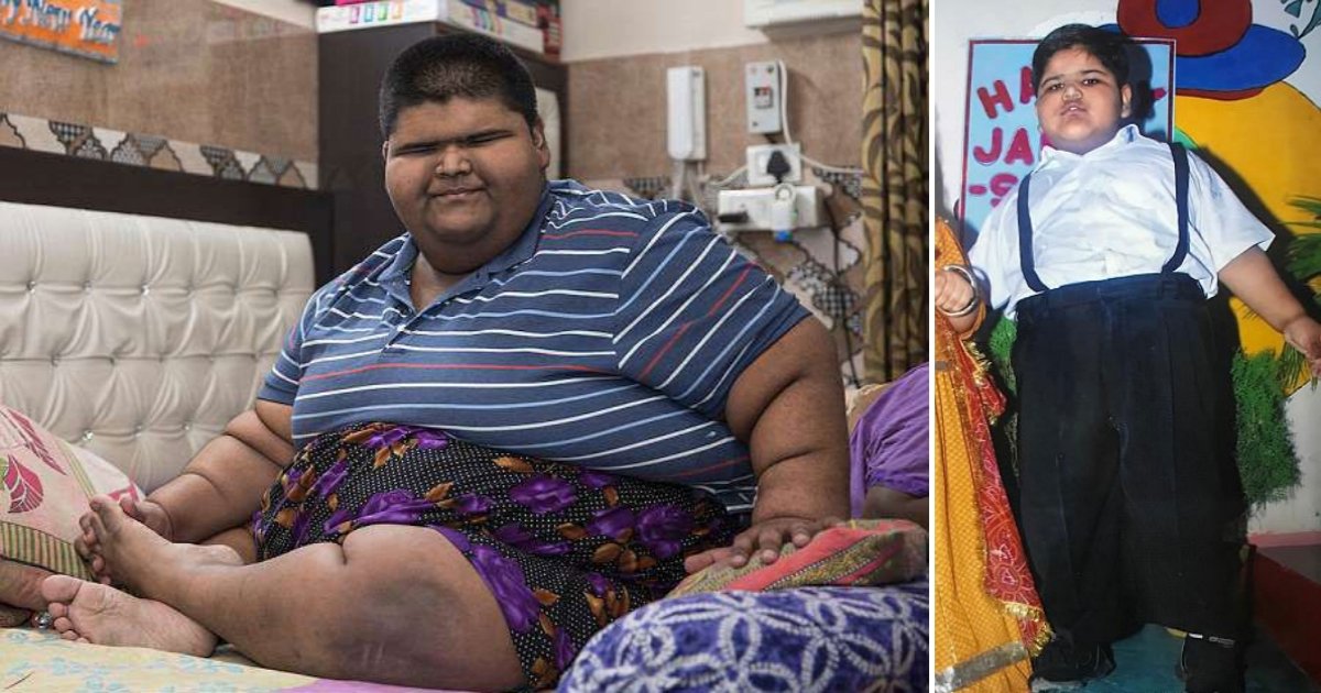 mihir heaviestchild surgery side.jpg?resize=412,275 - L'enfant le plus lourd du monde qui pesait plus de 237 kg perd 65 kg en deux mois