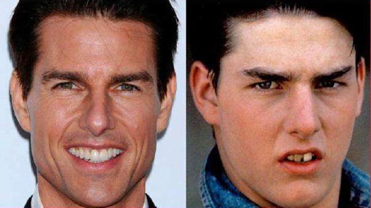 tom cruise celebrities having fake teeth amazingplace2travel.jpg?resize=412,275 - 10 celebridades que possuem dentes falsos
