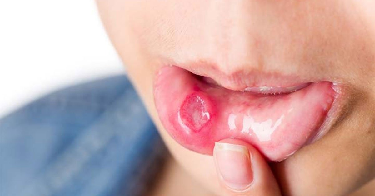Cáncer oral: signos y síntomas, factores de riesgo y cómo prevenirlo - Va a gustarme