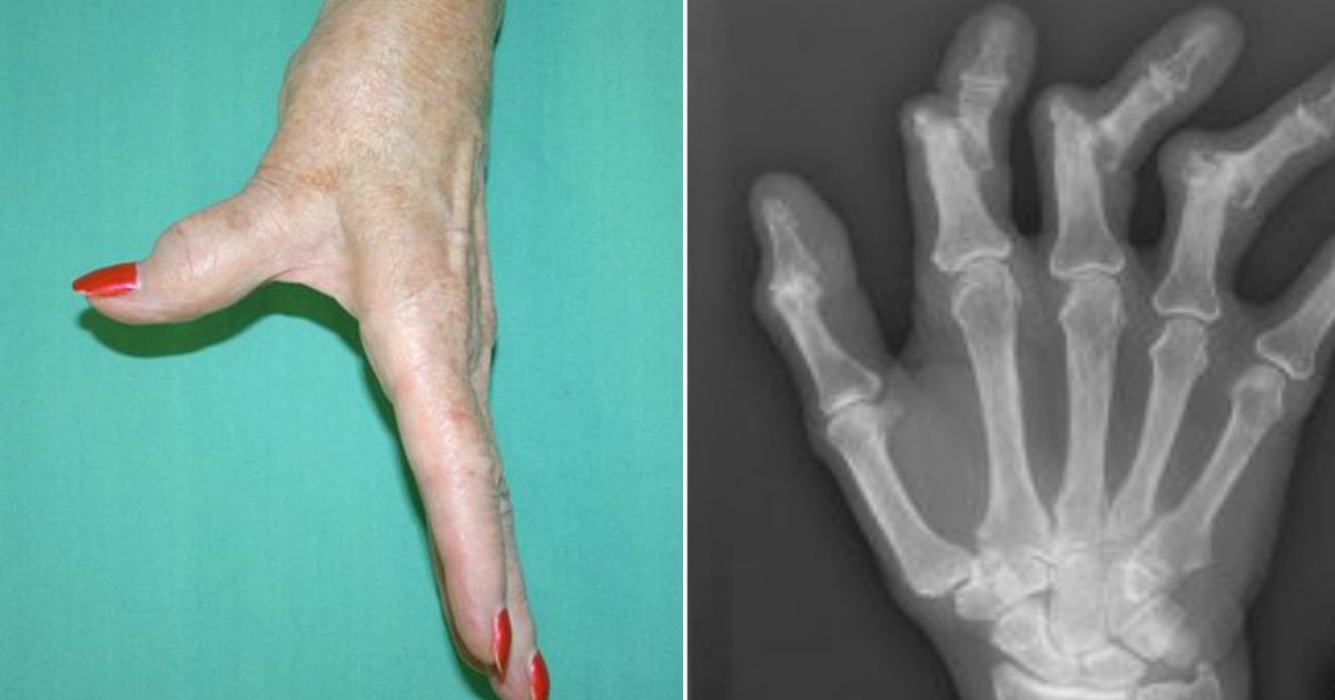 arthritis.jpg?resize=412,275 - 5 Early Signs Of Arthritis People Should Be Aware Of