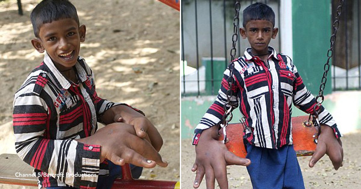 mano.jpg?resize=1200,630 - Después de una cirugía cambian la vida de un niño de 8 años con manos gigantes