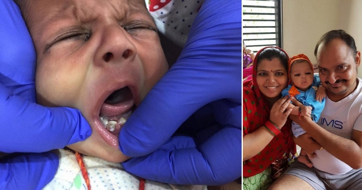 teeth.jpg?resize=1200,630 - La mère était sur le point d'allaiter son bébé pour la 1e fois... mais trouve 7 dents dans sa bouche !
