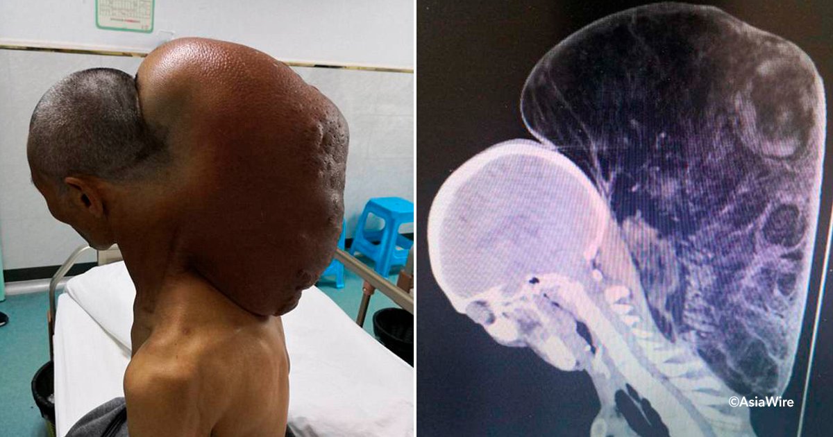 tumor.jpg?resize=412,232 - Un tumor masivo en el cuello de un hombre ha sido eliminado después de 47 años