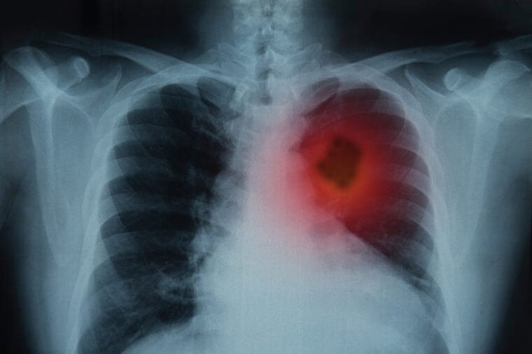 Lung Cancer. X-ray image of patient lungs to lung tumor.