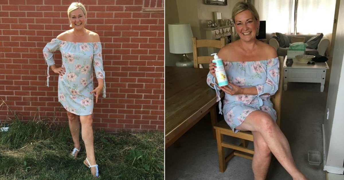 baby cream.jpg?resize=412,232 - Thanks To This Cream For Babies, Woman With Severe Psoriasis Finally Bares Her Legs After 20 Years Of Wearing Tights