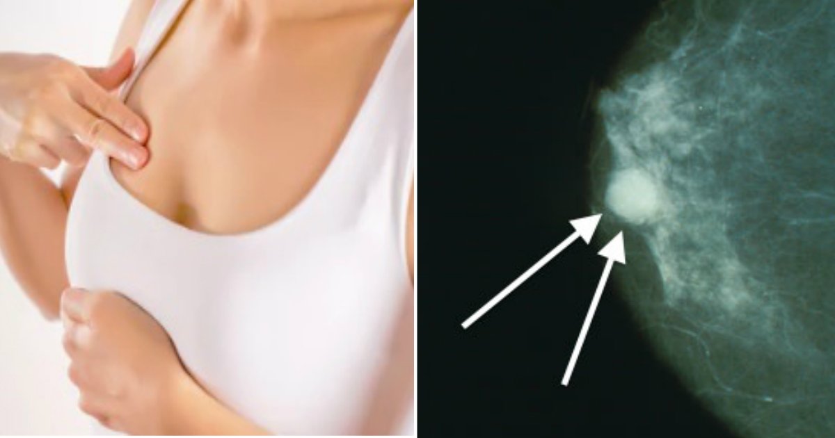 breast cancer early signs.jpg?fit=1024%2C538&ssl=1&strip=all - Early Breast Cancer Warning Signs That You Should Never Ignore