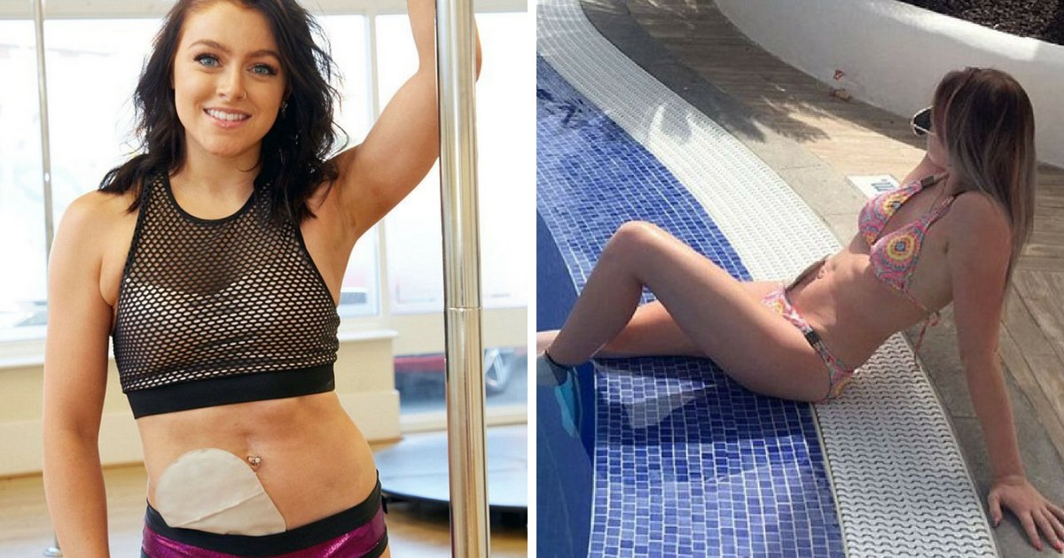 chloe6.png?resize=412,232 - Pole Dancer Wears Colostomy Bag With Pride To Defy A Nurse Who Told Her ‘She’d Never Be Able To Wear Bikinis Again’
