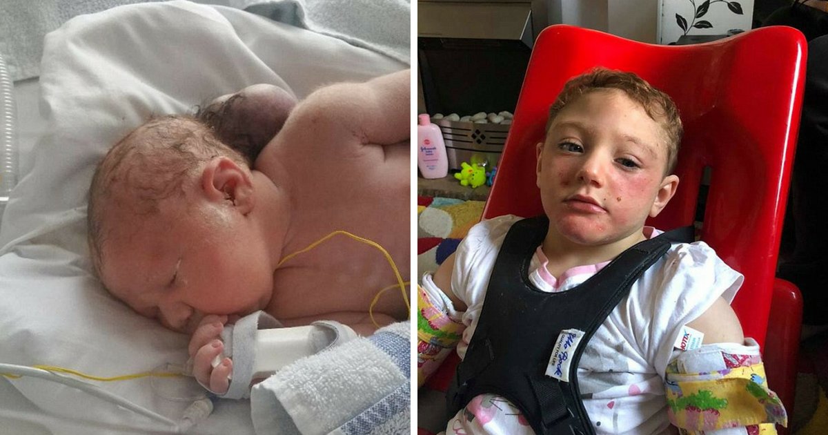 Miracle Baby Born With Brain Outside Her Head – Now 3, She Has Defied ...