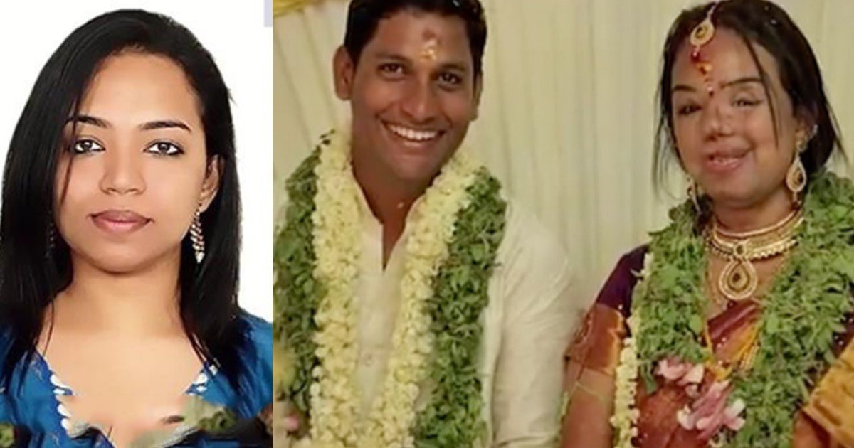 featured image 7.jpg?resize=1200,630 - Un Indien demande en mariage sa petite amie après que son visage ait été défiguré dans un accident.