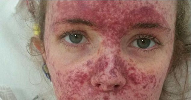 rash