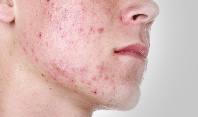 Acne breakout Acne breakout