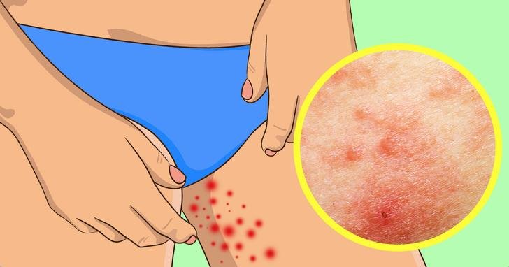 Irritation in thigh skin