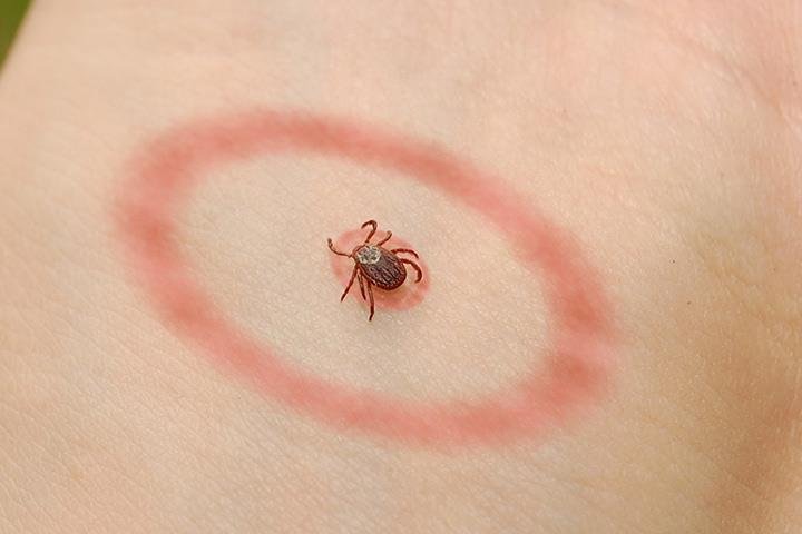 Lyme disease Lyme disease