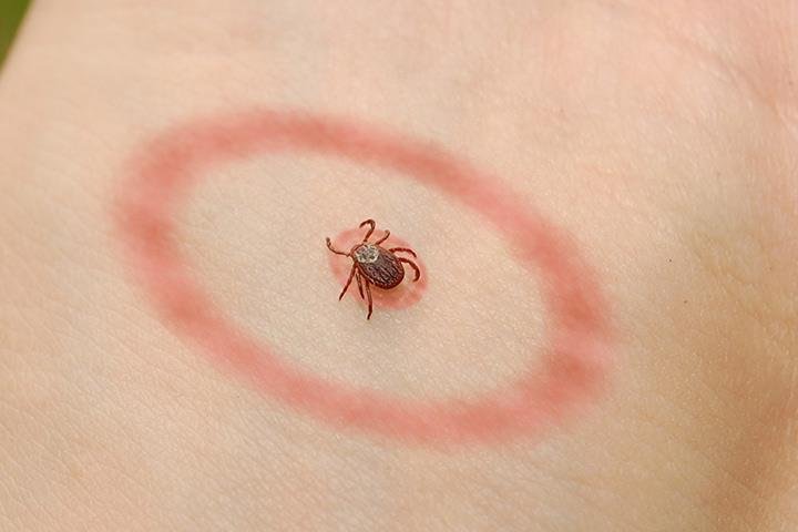 Lyme disease