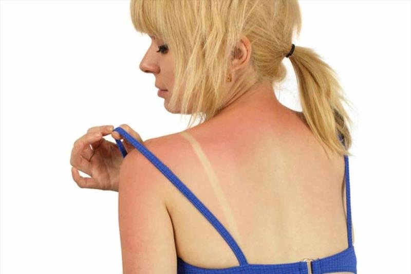 Sunburns Sunburns