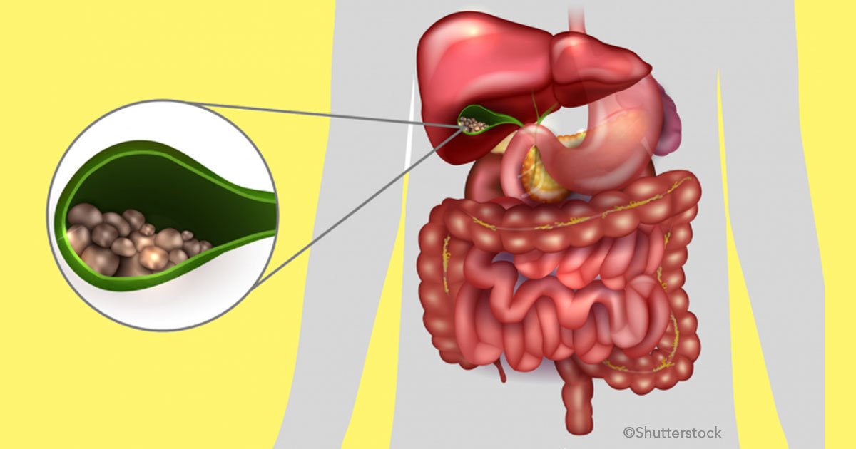 untitled 1 46.jpg?resize=412,275 - Cálculos en la vesícula: cómo se forman, síntomas y tratamiento